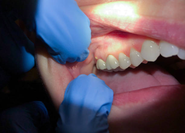 Best Emergency Treatment for Dental Infections or Abscesses in Coronita, CA